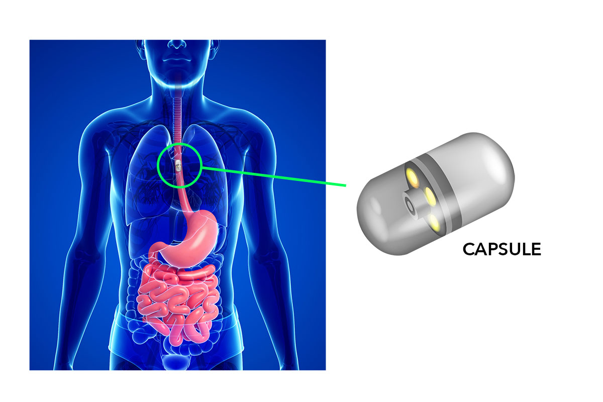 Capsule Endoscopy