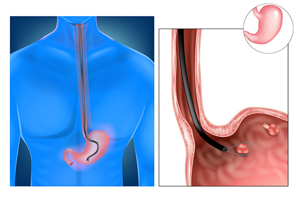 Upper Endoscopy (EGD)