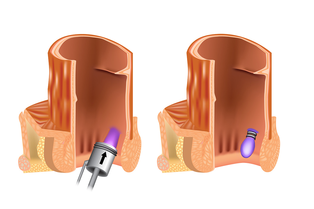 Hemorrhoid banding